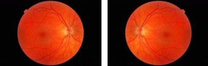 retinal images